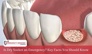 Image result for Dry Socket