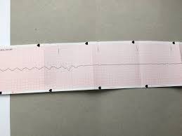 ECG of the day (@ECGoftheday)  X