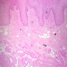 Image result for Filiform Papillae