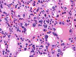 Graves' disease is an autoimmune disorder that causes hyperthyroidism, or overactive thyroid. Cytopathology In The Thyroid Of Graves Disease Springerlink