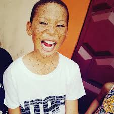 This is Lumiere aka Grace Esther, from Douala, Cameroon. She was orphaned  since birth and suffers with Waardenburg syndrome,...