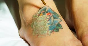 Im desperate to remove my tattoo i got wen i was 17. Eraser Clinic Brings Multi Wavelength Astanza Trinity Laser Tattoo Removal To Houston Tx