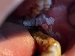Image result for gum cancer symptoms