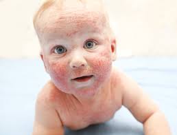 Baby body wash, baby shampoos, baby lotions & creams, baby wipes Is It A Rash Or Baby Acne Wehavekids