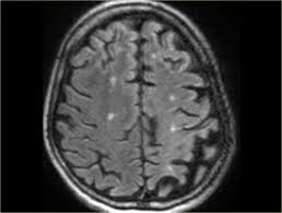Lewy body dementia (lbd) is a type of progressive dementia. The Radiology Assistant Dementia Role Of Mri