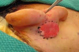 Image result for Spitz Nevus