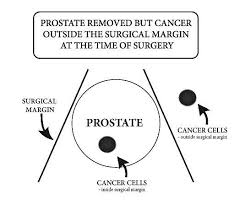 After treatment, that number should be low. Prostate Cancer After Radical Prostatectomy How Is It Possible Yuan Ade Sukma S Blog