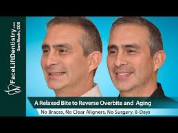 We did not find results for: Overbite Fix No Braces No Aligners No Surgery 8 Days