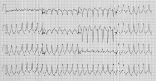 Vt Versus Svt With Aberrancy Emergency Medicine Medical Education Education Blog