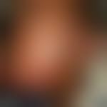 Image result for herpes zoster