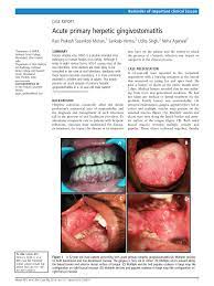 A number of viruses, all members of the enterovirus family, cause herpangina. Pdf Acute Primary Herpetic Gingivostomatitis