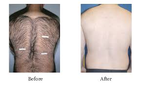 There are many benefits of vectus to the patient. Laser Hair Removal Summit County Co