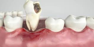 A need to create space before an orthodontic treatment. Teeth Removal Baton Rouge Tooth Extractions Wisdom Teeth
