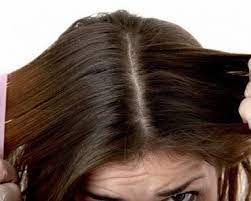 Kepege Karsi Bitkisel Cozum Hair Loss Treatment Hair Dandruff Dandruff Treatment