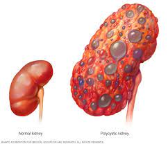 This is a medical term for kidney disease that requires dialysis or kidney transplant for a what is pd? End Stage Renal Disease Symptoms And Causes Mayo Clinic