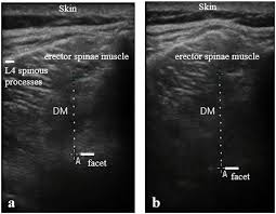 There exist different muscles, which we have covered in class over the past few wee. Representative Ultrasound Images Of The Deep Multifidus Dm From A Download Scientific Diagram