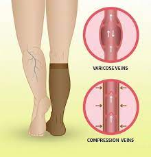 Pin On Varicose Veins Treatment How To Get Rid Of Essential Oils And Remedy