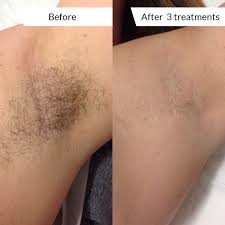 Laser hair removal is a convenient, noninvasive method for permanently reducing or removing unwanted facial or body hair. Rothwell Garforth Leeds Laser Hair Removal Treatments