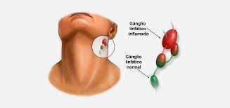 Linfoma de hodgkin y linfoma no hodgkin. Linfoma De Hodgkin