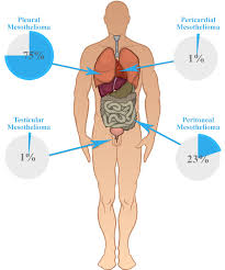We did not find results for: What Is Malignant Mesothelioma