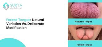 Image result for Fissured tongue