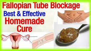 Leafy greens such as kale, alfalfa, chlorella, wheat grass, or barley grass probiotics such as yogurt (adding a cup of yogurt to your daily diet will reduce the risk of inhibiting bacteria) alkaline forming and. Natural Treatment For Blocked Fallopian Tubes 18 Things To Try Fallopian Tube Treatment In Delhi