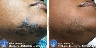 African americans, who often have skin troubles due to ingrown hairs, can permanently solve that problem with laser hair removal. Before After Electrolysis Hair Removal Mishael S Electrolysis Center