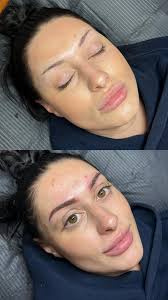 Cosmetic tattooing for natural-looking brows