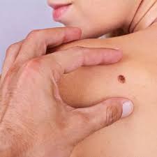 Warts Removal Cost in Dubai, UAE - Laser Skin Care Clinic Dubai