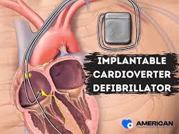 Image result for Internal Cardiac Defibrillator