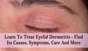 The symptoms of eyelid dermatitis usually occur within a few hours or days after the contact with the allergen or the trigger substance. Learn To Treat Eyelid Dermatitis Find Its Causes Symptoms Care And More If You Ever Find That You Have Eyeli Eyelid Dermatitis Eczema On Eyelids Eye Eczema