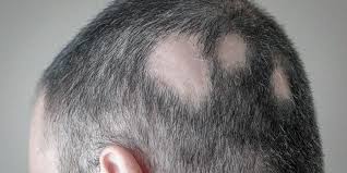 Fungal Hair Loss - Asmed Hair Transplant