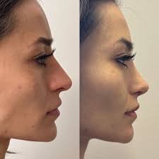 Nose Procedures