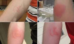 Gigitan hama (scabbies), kutu, pepijat atau cacing halus. Insect Expert Allows 1 000 Bedbugs To Give Him Tattoo On His Arm Daily Mail Online