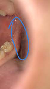 I feel this info is pretty damn important for most people to know, so share what you have, please. Does This Look Like Oral Cancer Diagnoseme