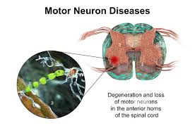 Motor Neuron Disease - Causes, Symptoms, Treatment | Max Lab