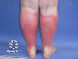 Image result for Lipodermatosclerosis