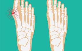 We did not find results for: Dont Ignore Your Bunion Pain Find Out Your Treatment Options