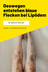 Dr Gerlach Erklart Deswegen Entstehen Blaue Flecken Bei Lipodem