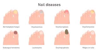 Image result for Onycholysis feet