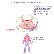 Image result for Syringomyelia