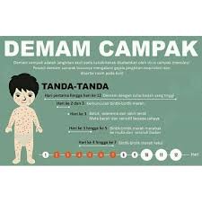 Terdapat empat (4) jenis virus yang boleh menyebabkan demam denggi (den 1, den 2, den 3 dan den 4). Set Rawatan Demam Campak Shopee Malaysia