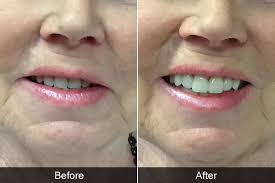 As with all of our dental implant patients here in north london, we'll take. Dentures Before After Pictures Kevin Manners Denture Clinics