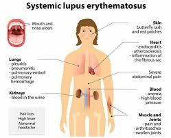 Systemic Lupus Erythematosus Essential Oils For Lupus Lupus Symptoms Lupus