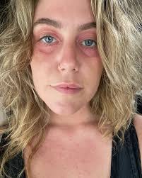 Embracing the Journey: A Path to Healing and Self-Love For roughly 8 years,  off and on, leading to a constant state of battling debilitating symptoms—  Eczema, attention issues, exhaustion, gut issues, and