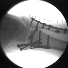 Injury fears spur regulations for indoor trampoline parks