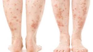 Usually, this type of hives is caused by food or drug reactions. How Long Do Skin Allergy Breakouts Last Howstuffworks