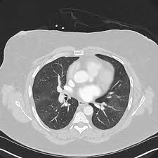 Lung nodules — small masses of tissue in the lung — are quite common. Mosaic Attenuation Of Lung Parenchyma Radiology Case Radiopaedia Org