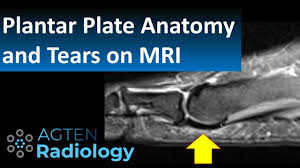 Mri patterns of neuromuscular disease involvement thigh & other muscles 2. How To Assess Plantar Plate Anatomy And Tears On Mri Youtube