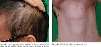 Cherry angiomas are red moles on your skin which contain an abnormal amount of blood vessels. Indian Journal Of Dermatology Venereology And Leprology Multiple Cherry Angiomas And Pyogenic Granuloma In A Patient Treated With Ramucirumab And Paclitaxel